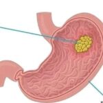 Stomach Cancer: 5 Things To Avoid Taking Too Much If You Want To Protect Your Health