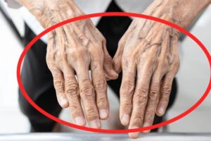 5 Reasons Why Some People Have Visible Veins Showing Through Their Skin  Have you ever noticed that some people have veins that are clearly visible on their hands, arms, legs, or other parts of their bodies, while others have veins that are barely noticeable? In many cases, this is completely normal. However, certain changes in the appearance of veins may sometimes require medical attention.  Here are five reasons why veins may become more visible beneath the skin.  1. Naturally Thin Skin  Some people have thinner skin, making the veins underneath easier to see. This can be influenced by genetics and may become more noticeable as a person gets older. If your veins have always been visible and have not changed suddenly, it is often a normal physical characteristic.  2. Low Body Fat  People with lower body fat may have more visible veins because there is less fatty tissue between the skin and the blood vessels. This is common among naturally slim individuals and people who exercise regularly. Visible veins alone do not necessarily mean someone is unhealthy or underweight.  3. Regular Exercise  Physical activity can temporarily make veins more prominent because exercise increases blood flow to working muscles. Strength training may also increase muscle size, pushing veins closer to the skin’s surface. This is particularly noticeable after workouts and is often harmless.  4. Hot Weather And High Temperatures  When your body gets hot, blood vessels near the skin can widen to help release heat. As a result, veins may appear more noticeable, especially on your hands and arms. Their appearance often returns to normal when your body cools down.  5. Ageing And Changes In The Veins  As people age, their skin may become thinner and lose some of its elasticity, making veins easier to see. In addition, weakened vein valves can contribute to varicose veins, which often appear enlarged, twisted, or raised, particularly in the legs.  When Should You Be Concerned?  Visible veins are usually harmless when they have been present for a long time without other symptoms. However, seek medical attention if a vein becomes suddenly prominent or is accompanied by pain, redness, warmth, or swelling. Sudden swelling or pain in one leg needs urgent assessment.  Remember: The visibility of your veins alone does not tell you whether your blood circulation is good or bad. Their appearance depends on several factors, including genetics, skin thickness, body fat, temperature, and physical activity.