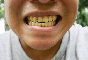 4 Daily Mistakes That Can Make Your Teeth Turn Yellow Without You Realising