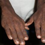 4 Possible HIV Warning Signs Men Should Know