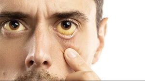 Why Your Eyes Are Turning Yellow: 4 Possible Causes You Should Know