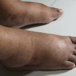4 Signs of Diabetes in Men You Should Never Ignore