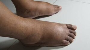 4 Signs of Diabetes in Men You Should Never Ignore