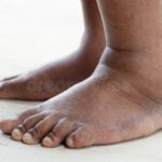 5 Parts Of Your Body That Experience Pain When Your Blood Sugar Is Too High