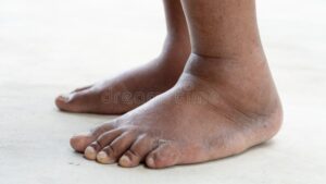 5 Parts Of Your Body That Experience Pain When Your Blood Sugar Is Too High